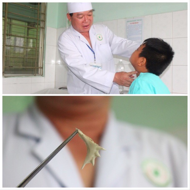 Bác sĩ Ngô Văn Phan thăm khám cho bệnh nhân chiều ngày 5-11. Ảnh trái: Hình thù chiếc xương cá bị bệnh nhi nuốt phải.