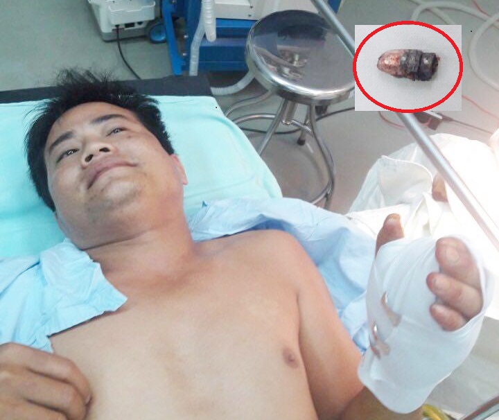 Anh Nguyễn Văn Hùng và đầu đạn được phẫu thuật lấy ra từ bàn tay
