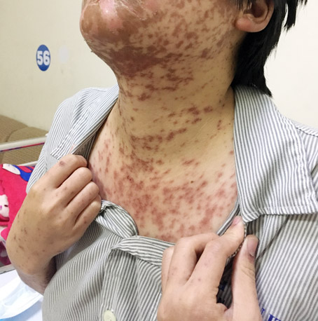 Bệnh nhân Trần Thị Hoàng H.bị nổi mẩn đỏ khắp người vì dị ứng thuốc. Ảnh: A.Thư