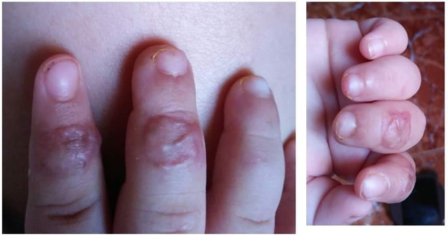 đốt ngón tay phục hồi sau 1,5 tháng 