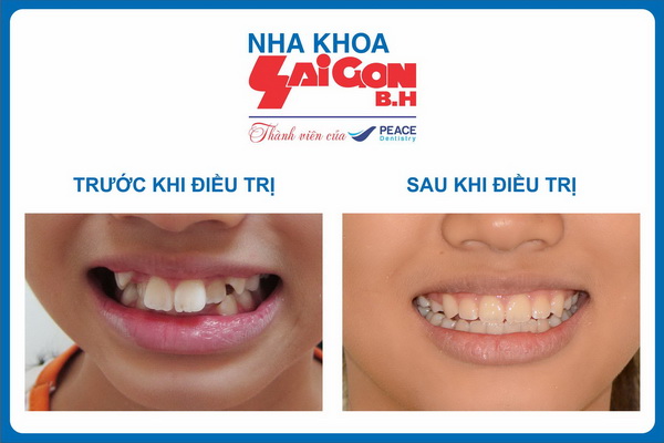 Niềng răng trước và sau