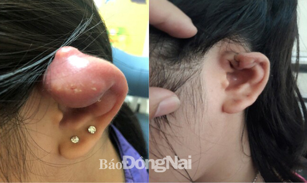vành tai bị áp xe sau khi xỏ khuyên tai (ảnh trái)  và vành tai sau khi được điều trị tại Bệnh viện nhi đồng Đồng Nai (phải) 