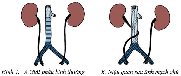Hình ảnh giải phẫu bình thường về vị trí của niệu quản phải trong cơ thể (ảnh trái) và hình ảnh về vị trí niệu quản phải nằm phía sau tĩnh mạch chủ của bệnh nhân G (ảnh phải).