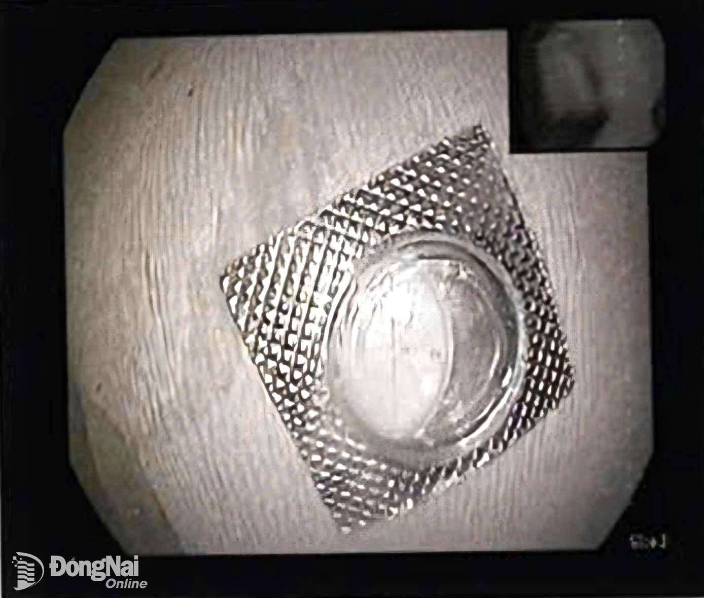 Gắp viên thuốc còn nguyên vỏ sắc nhọn kẹt trong thực quản nữ bệnh nhân