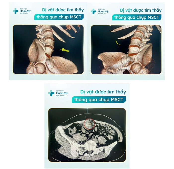 Xương cá khô xuyên đường tiêu hóa - Bệnh nhân nhập viện trong đêm