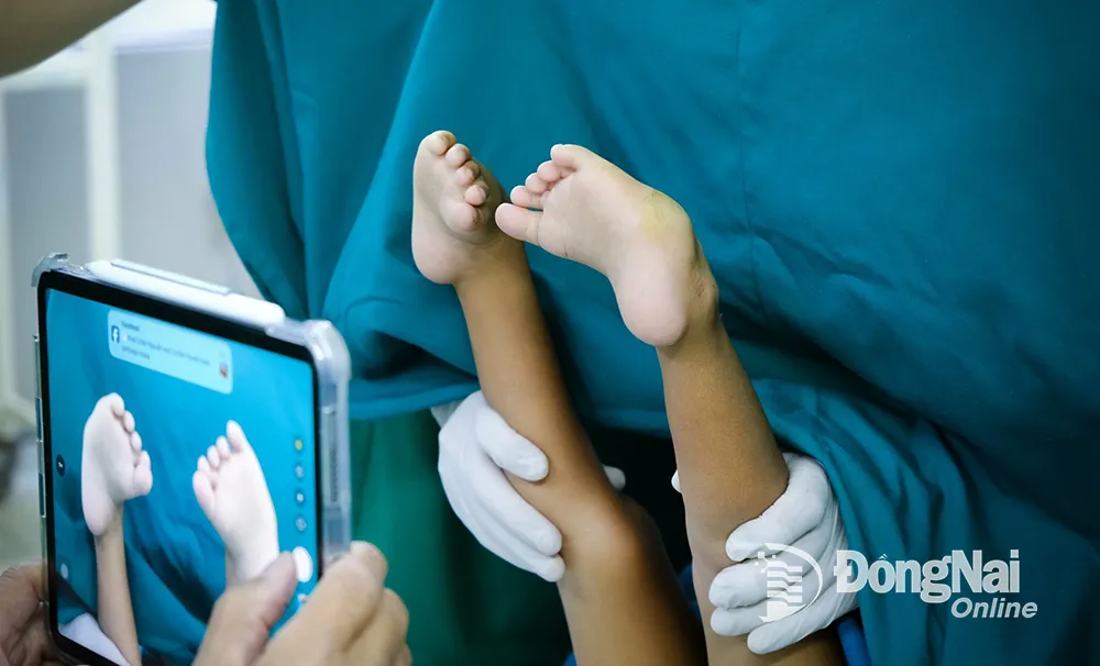 Bàn chân khoèo khiến em T. đi lại khó khăn suốt nhiều năm. Ảnh: Bích Nhàn