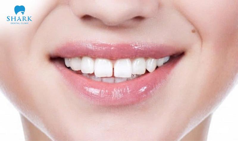 Trám răng giúp cải thiện răng thưa hở, mang lại nụ cười tự tin.