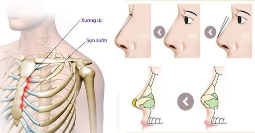 Nâng mũi sụn sườn giải pháp cứu cánh cho những trường hợp mũi bị hỏng