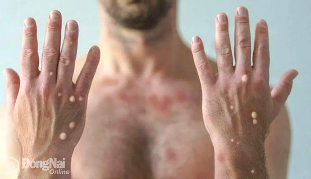Những bóng nước nổi trên tay bệnh nhân đậu mùa khỉ (ảnh: ITN)