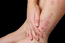 Thường xuyên ngứa, nổi sẩn đỏ, làm sao trị dứt điểm?