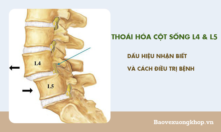 Bài văn mẫu 8: Chấn thương thể thao và nguy cơ thoái hóa cột sống