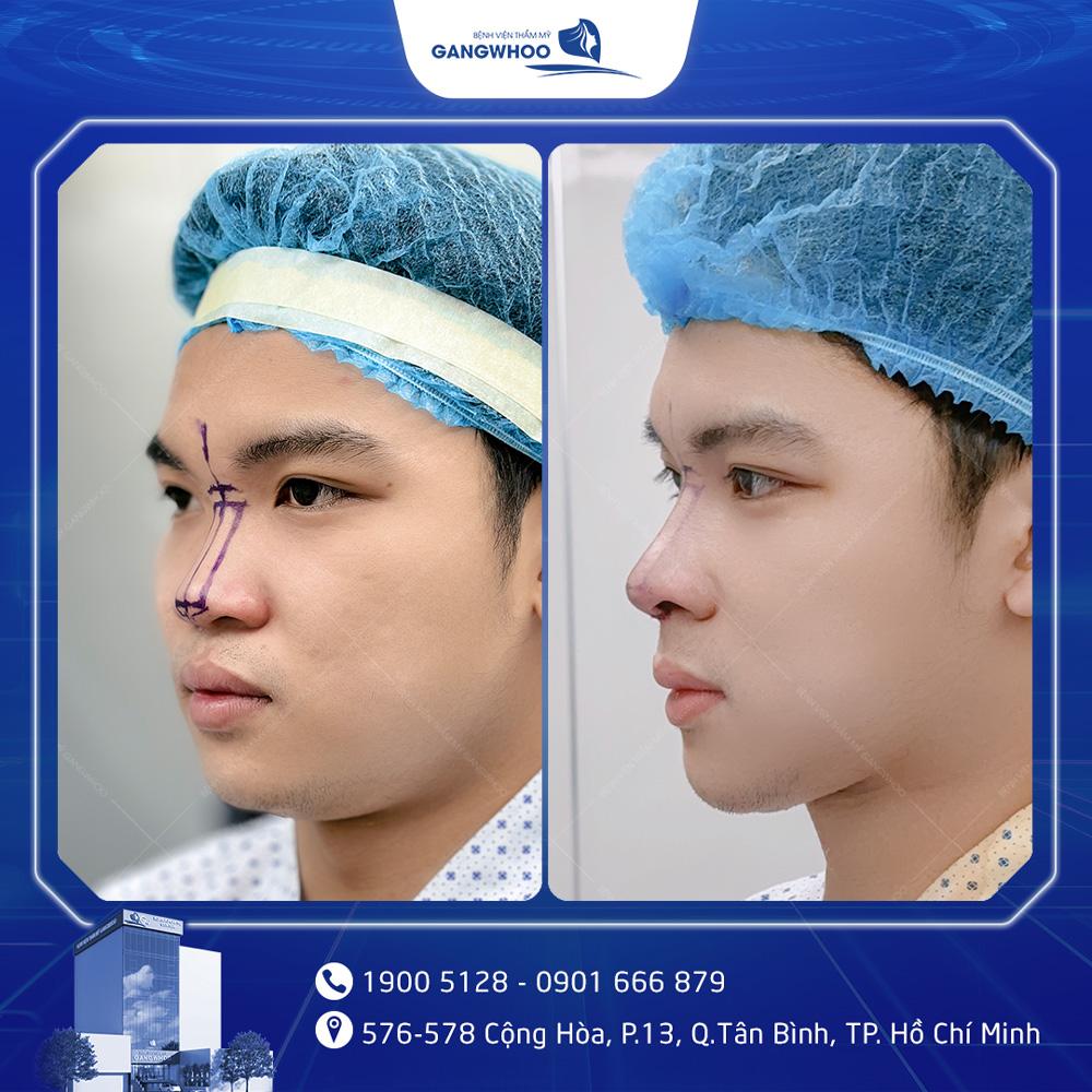 Khách hàng thực hiện nâng mũi tại Bệnh viên thẩm mỹ Gangwhoo.