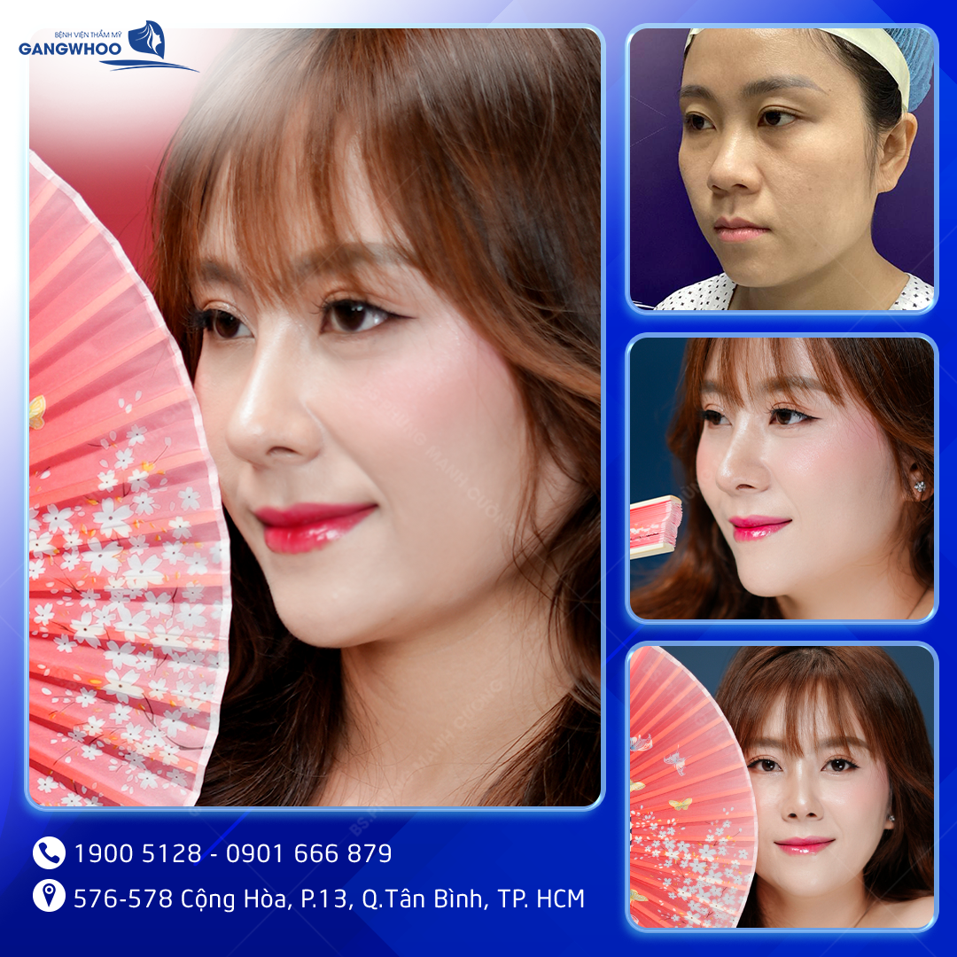 Khách hàng thực hiện nâng mũi tại Bệnh viện thẩm mỹ Gangwhoo.