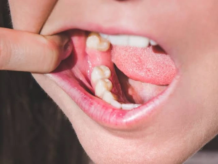 Nhổ răng bao lâu thì trồng Implant được? Có phải lúc nào cũng cần chờ vài tháng?