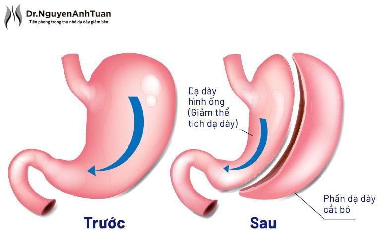 Mô tả phương pháp thu nhỏ dạ dày giảm cân.