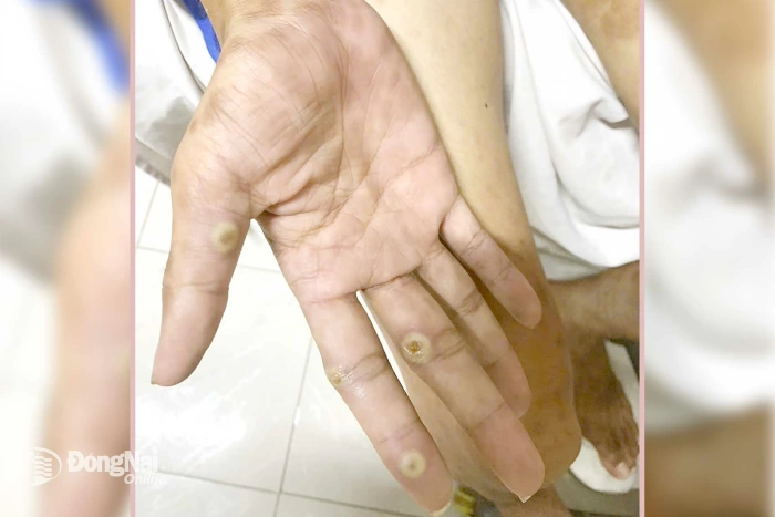 Trảng Bom phát hiện ca đậu mùa khỉ đầu tiên, chưa rõ nguồn lây