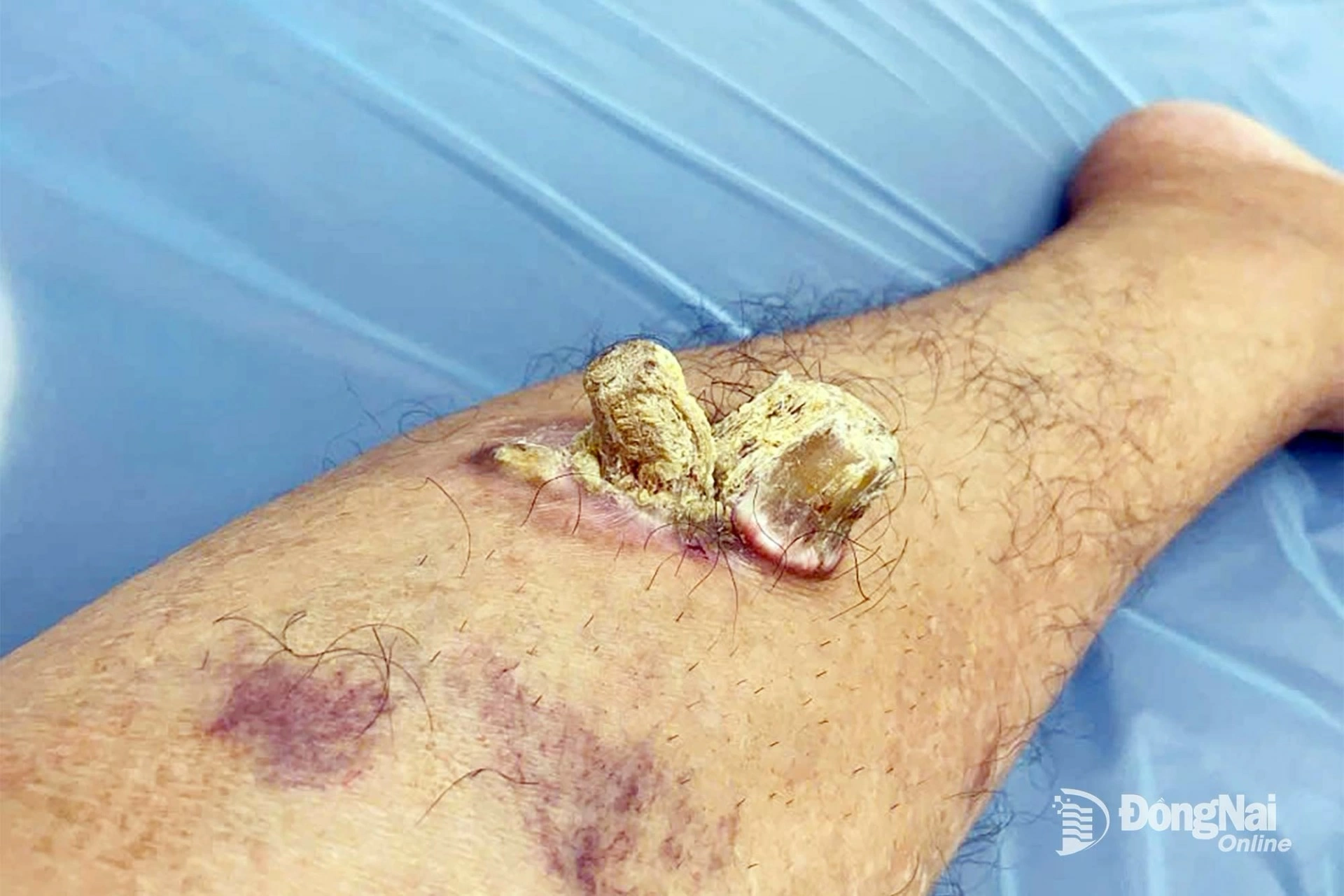 Hình ảnh khối u nhú tế bào gai sừng hóa trên chân phải bệnh nhân trước khi bị loại bỏ. Ảnh: CTV