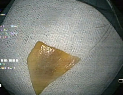 Hình ảnh dị vật xương vịt sau khi được gắp ra ngoài.