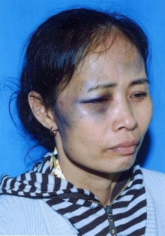 Tran Thi Hanh suffered multiple injuries after being brutalized by a bus inspector