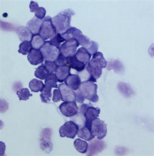 An image of malignant blood cells in the bone marrow (termed ''leukemic blasts'') of a patient with acute myeloid leukemia is seen in this handout photo. 