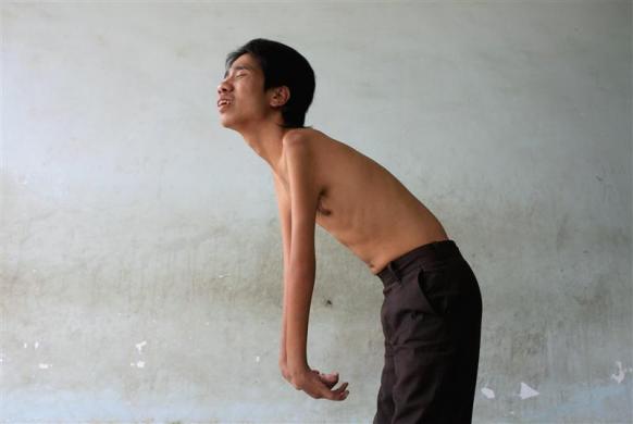 2.	Hong, 24, who claims to be a victim of Agent Orange, stands on the front porch of his housing at the Friendship Village project in Hanoi November 15, 2006.