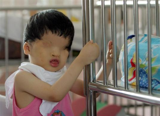 4.	Vietnamese defoliant Agent Orange Victim Tran Huynh Thuong Sinh, 4, is seen at the Peace Village in Ho Chi Minh city, September 15, 2006.