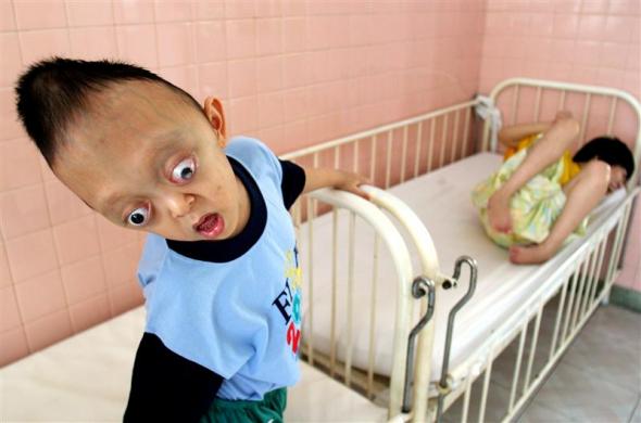 5.	Vietnamese defoliant Agent Orange Victims Nguyen Xuan Minh (L), 5, and Nguyen Thi Thuy Giang, 25, of Hanoi are seen at the Peace Village in Ho Chi Minh city, September 15, 2006.