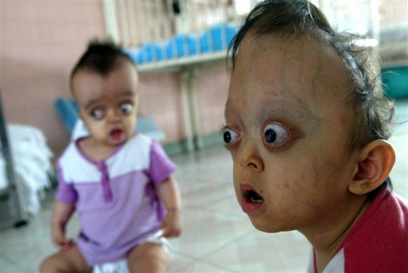 8.	Children born with deformities sit in the Peace Village at Tu Du hopsital in Ho Chi Minh City, February 3, 2004.