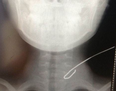Doctors save boy from severe neck injury