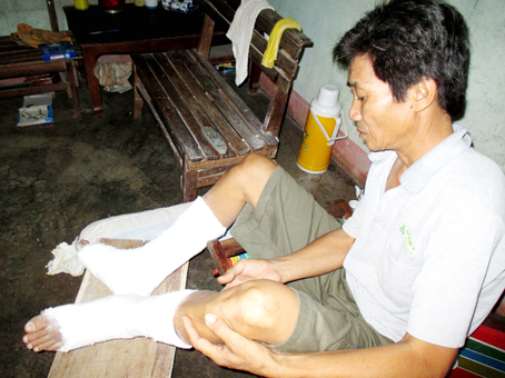 Anh Nguyễn Đức Tuân với 2 chân bị gãy phải bó bột. Ảnh: Đ.Phú