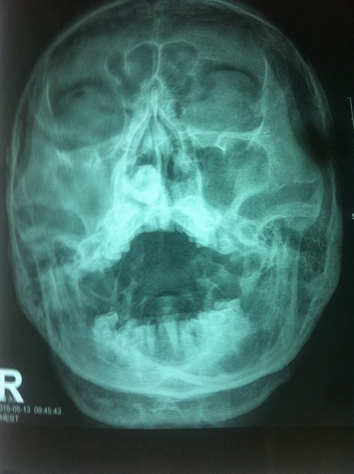 Man spends 80 years with a pebble stuck in his nose