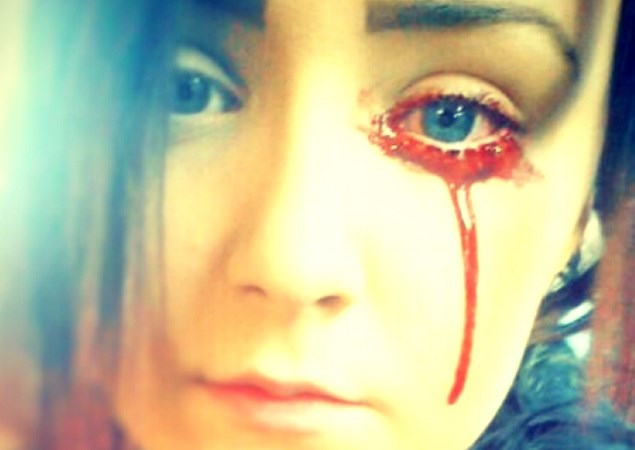 Cô gái 17 tuổi bị chảy máu mắt. (Nguồn: BBC)
