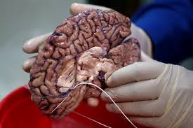 A doctor holds a human brain in a brain bank in the Bronx borough of New York City, New York, U.S. June 28, 2017. 