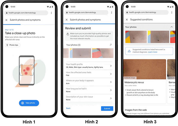 Hình 1: Dùng máy ảnh trên smartphone chụp vùng da bị tổn thương (chụp 3 ảnh). Hình 2: Khai báo các thông tin bệnh lý. Hình 3: Nhận kết quả chẩn đoán của Google. Nguồn: Google, xử lý ảnh: PHN