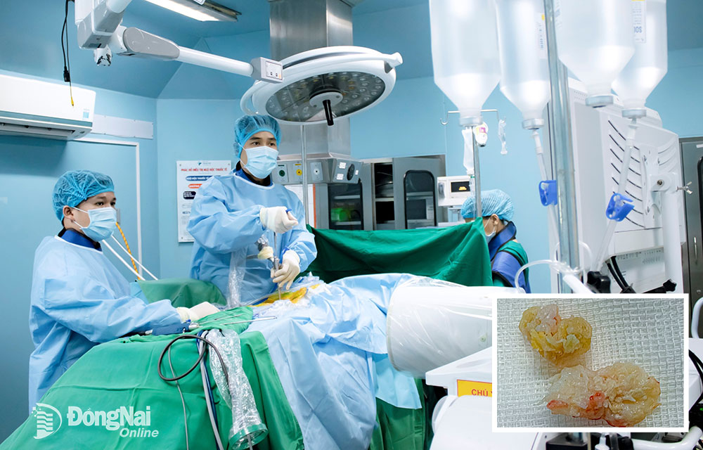 Các bác sĩ thực hiện ca phẫu thuật nội soi cột sống hoàn toàn điều trị thoát vị đĩa đệm cột sống thắt lưng cho bệnh nhân và nhân đệm được lấy ra khỏi cột sống của bệnh nhân (ảnh nhỏ)