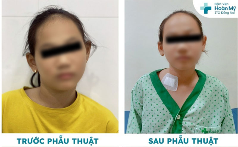 Hình ảnh cổ bệnh nhi trước và sau phẫu thuật (ảnh: BVCC)